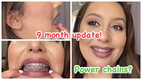 9 Month Braces Update Mid Journey Damon Braces No Extractions