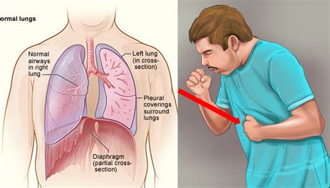 Tuberculosis C Mo Reconocer Las Se Ales Y Los S Ntomas Medicina