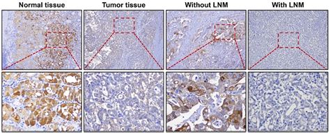 Aldob Plays A Tumor Suppressive Role By Inhibiting Akt Activation In