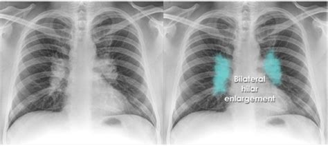 Intro Radiology And Chest Radiology Flashcards Quizlet