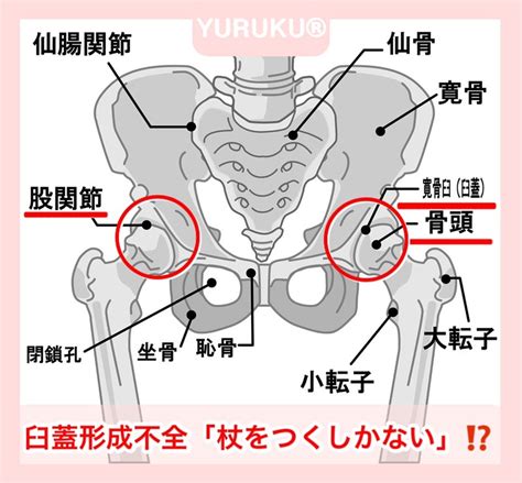 臼蓋形成不全「杖をつくしかない」！？ Yurukuウォーク考案者ノリコ＊膝下美脚・太もも痩せ・姿勢と歩き方改善