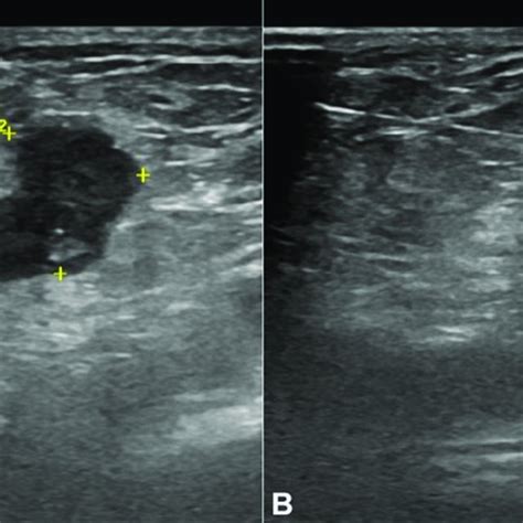 Inguinal ultrasound. Suspicious right inguinal adenomegaly measuring 20... | Download Scientific ...