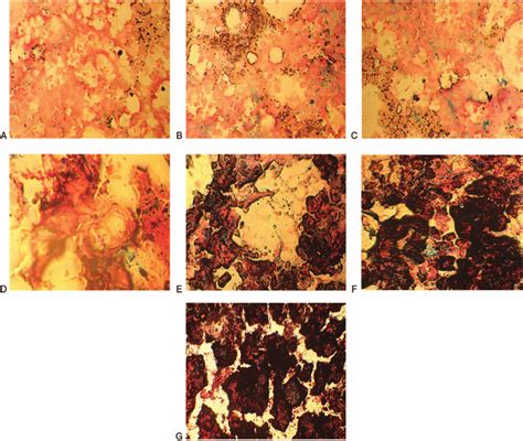 Perl Prussian Blue Staining For The Evaluation Of Bone Marrow Iron