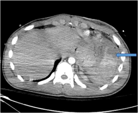 Ct Scan Abdomenpelvis With Iv Contrast Axial View Demonstrates Grade Download Scientific