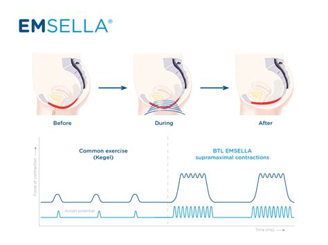 Emsella The Pelvic Floor Makeover Treatment That Will Help Cure Your