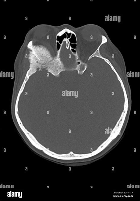 Intraosseous Meningioma Ct Scan Stock Photo Alamy