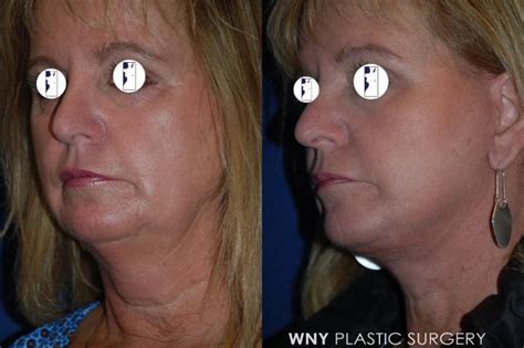 Facelift Before and After Pictures Case 211 | Buffalo, NY | WNY Plastic ...