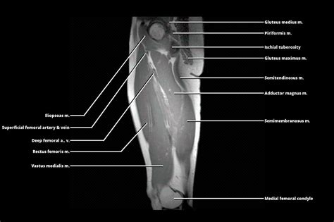 MRI - THIGH