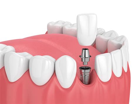 How Do Dental Implants Work Ddi Dorset