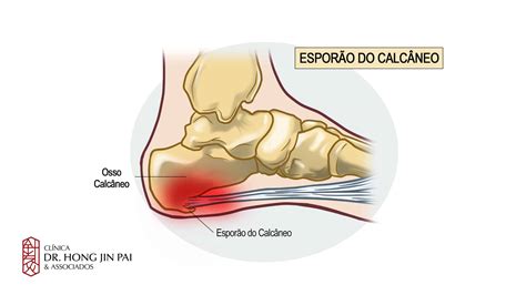 Dor No Calcanhar O Que Pode Ser Cl Nica Dr Hong Jin Pai Dor