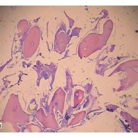 H E Stained Decalcified Section Showing A Disorganized Dental Tissue