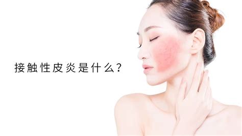 接触性皮炎是什么？ 周先勇主治医师 爱问医生