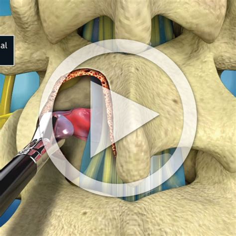 L Surgical Laminotomy Foraminotomy And Discectomy Procedure