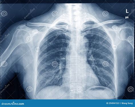 X-Ray Image Of Human Chest Stock Photos - Image: 29494153