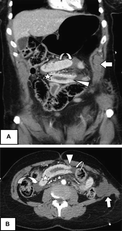 Degloving Bowel Injury Following Blunt Abdominal Trauma A Rare CT