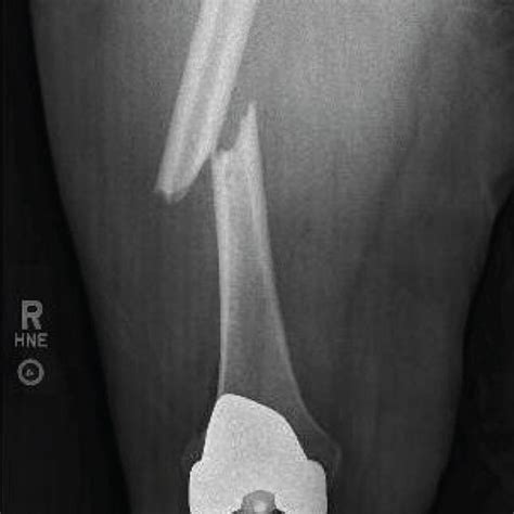 Anteroposterior Radiograph Of The Right Femur Demonstrating A Fracture