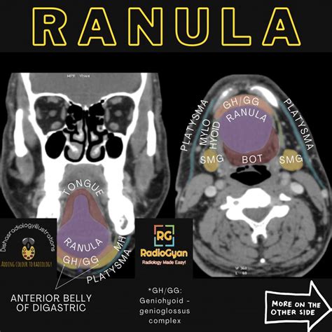 Ranula | Radiology Case | - RadioGyan