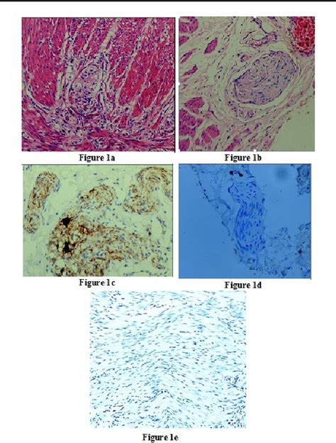 Figure 1 From Utility Of Calretinin Stain In Work Up Of Inadequate