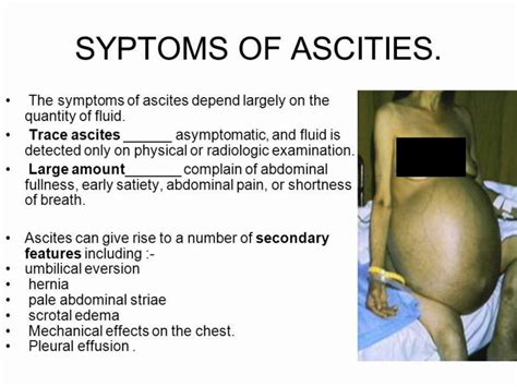 Ascites Symptoms | MedicineBTG.com