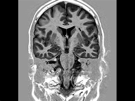 Hippocampus Philips Mr Body Map