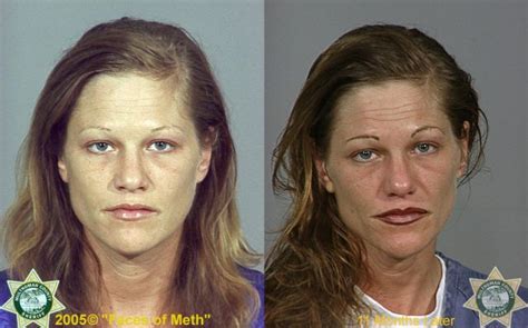 Meth Addicts Before And After 38 Pics