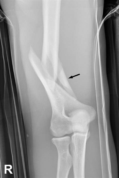 Figure 1 from Comminuted fracture with butterfly fragment of the ...