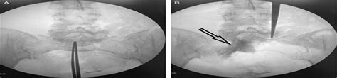 Superior Hypogastric Plexus Blocks for Postoperative Pain Ma... : The Clinical Journal of Pain