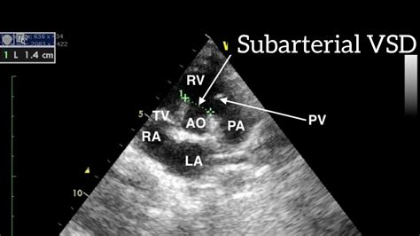 Subarterial VSD - YouTube