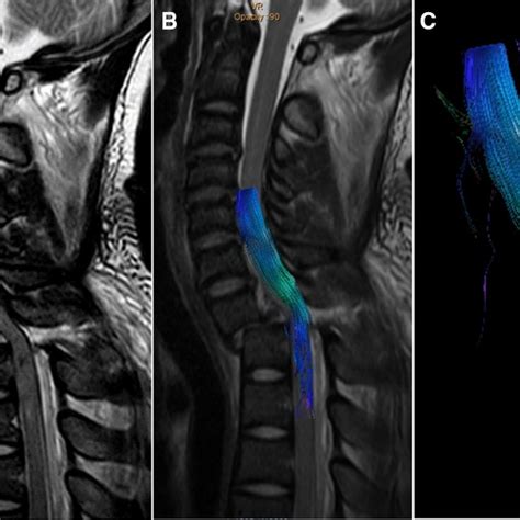 The novel diagnostic procedure based on conventional MRI and DTI-DTT ...