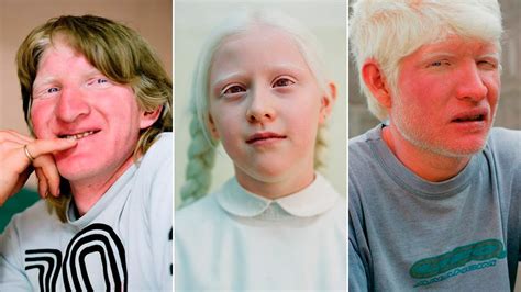 Conoce El Pueblo Secreto De Los Albinos En Frica Los Eliminan Por Que