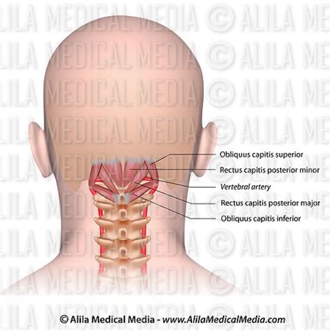 Alila Medical Media Suboccipital Muscles Medical Illustration