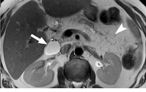 Retentional Cyst Of The Pancreatic Head In A 49 Year Old Woman With