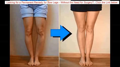 Bow Legged Surgery Knock Knees Exercises Youtube