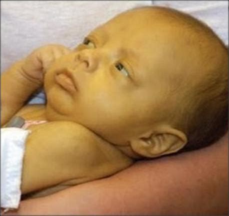 Icterícia Em Bebê De 1 Mês - ICTERÍCIA NEONATAL: CAUSAS, TRATAMENTO E TEMPO DE DURAÇÃO NO BEBÊ ...