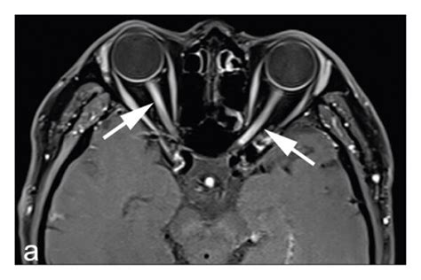 MRI identified optic nerve lesions in patients with methanol-induced ...