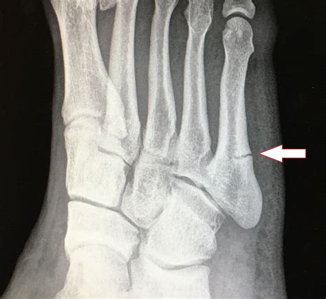 Fratura De Jones Tratamento Ortopedista Especialista Em Pé E Tornozelo Ortopedia Do Esporte