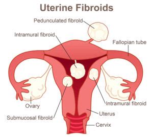 Unique Facts About Intramural Fibroids Kansas University