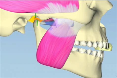 Digital Anterior Bite Plane Spear Education