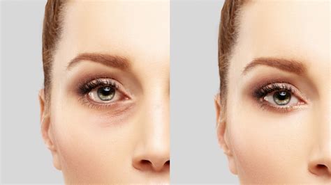 Non Surgical Blepharoplasty Iser