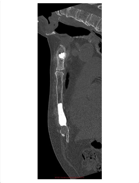 Post Operative Sagittal Computed Tomography Image Of Patient 1 Download Scientific Diagram