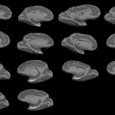 Fourteen Cases Were Labeled On High Resolution Ex Vivo Mri Volumes And