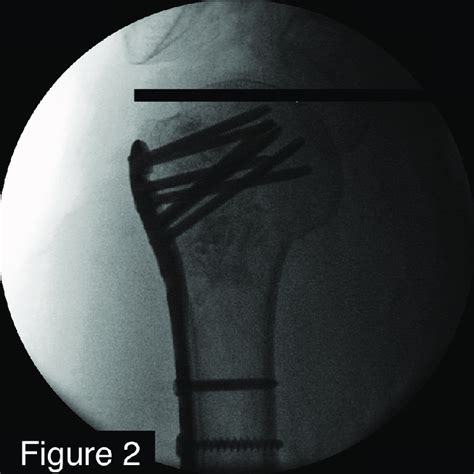 Fracture reduction and grafting was performed. | Download Scientific ...