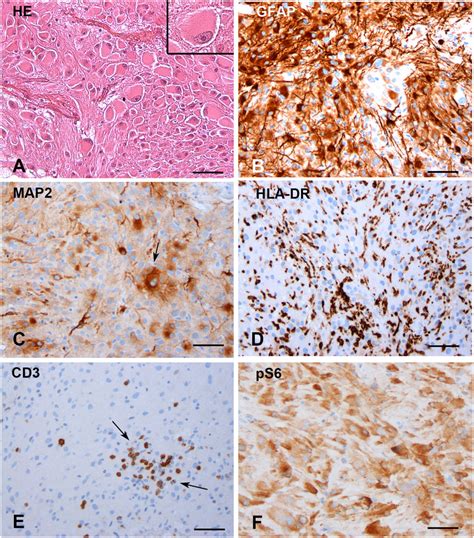 Subependymal Giant Cell Astrocytomas SEGAs A Hematoxylin And Eosin