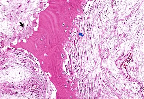 Pathology Outlines - Avascular necrosis