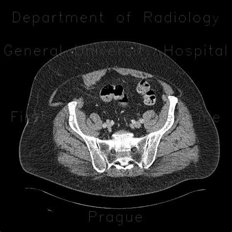 Radiology case: Spiegelian hernia