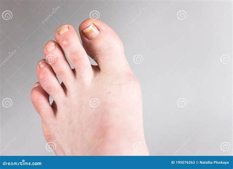 Damaged Toenail Top View Stock Image 216568543