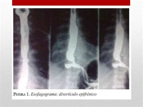Diverticulos Esofagicos