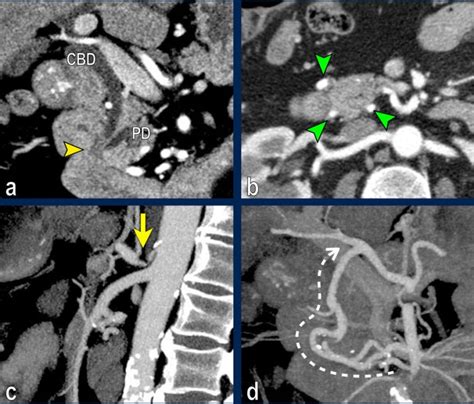 The Radiology Assistant Pancreatic Cancer Ct Staging 2 0