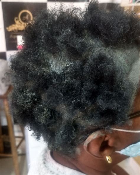 Massinha Branca No Couro Cabeludo Tratamento Caseiro