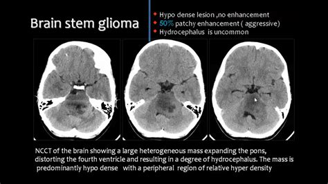 Posterior fossa | Brain stem, Neurology, Fossa